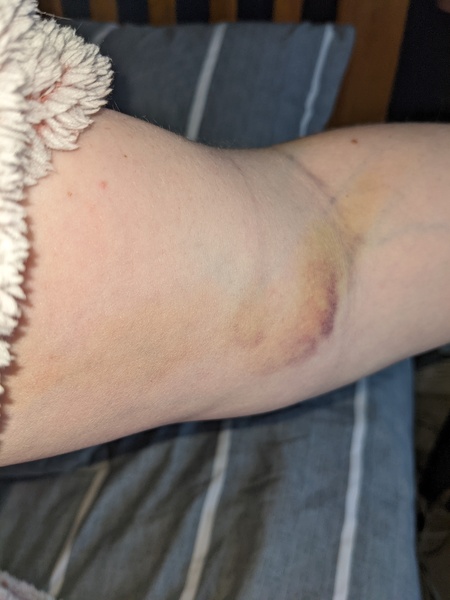 Where did this bruise come from?