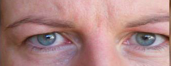 Eye lid surgery