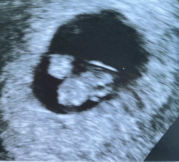 7 week ultrasound, twins or single & sack?