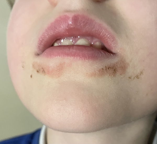 Mouth rash any ideas?