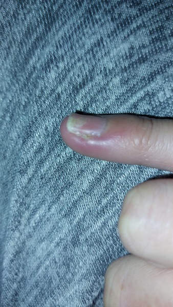 My pinkie is throbbing like mad (picture included)