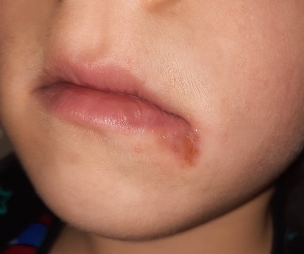 Is this a cold sore on 6yo? Worried I've passed virus to him *pic included*