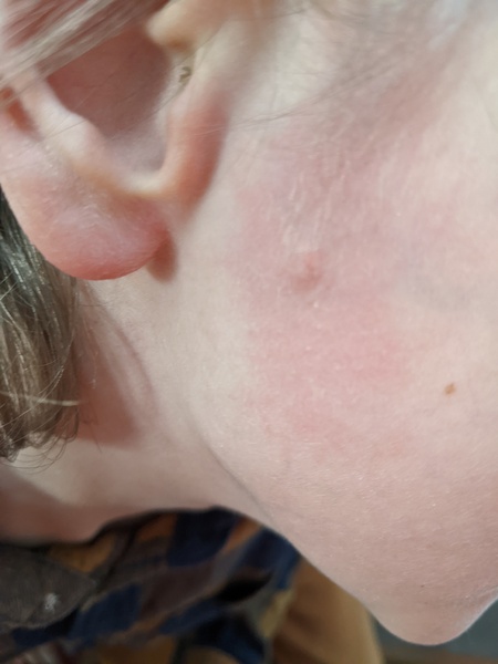 Strange spot on cheek