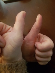 I think my thumb might fall off!! Please help