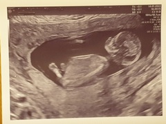Any ivf pregnancies ?