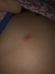Could this spot be cancer ? Or cherry aginoma , Picture included ,