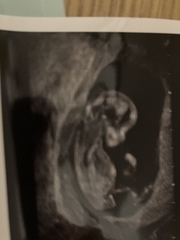 Any guesses? Boy or girl. 12 week scan