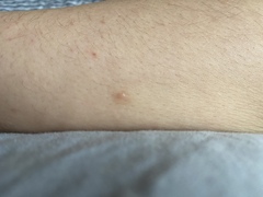 Nodular Melanoma? Any doctors around??