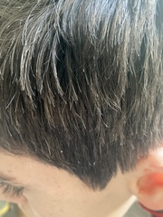 Dandruff or flaky scalp? Pic attached