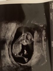 Any guesses? Boy or girl. 12 week scan