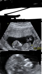 Boy nub that could maybe be a girl? 🙄 Yes. Im going crazy. Anyone in same situation?