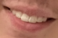 Braces and tooth extraction