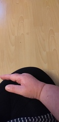 Edema for over 6 months. Dr seemingly disinterested