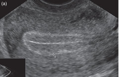 TTC with Letrozole/Clomid