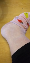 Edema for over 6 months. Dr seemingly disinterested