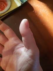 I think my thumb might fall off!! Please help