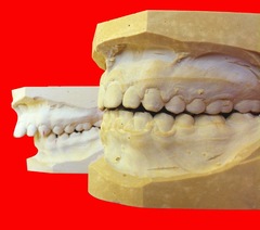 Twin block braces