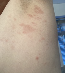 Red patch on left breast early pregnancy?