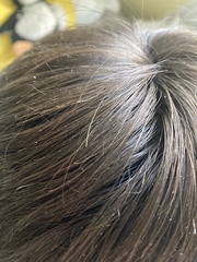 Dandruff or flaky scalp? Pic attached