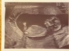 Any ivf pregnancies ?