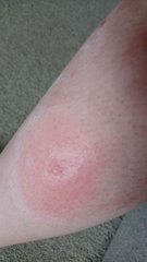 What was this bite? Posting for traffic