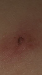 Could this spot be cancer ? Or cherry aginoma , Picture included ,