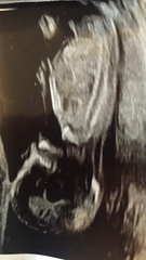 Any ivf pregnancies ?