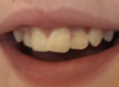 Braces and tooth extraction