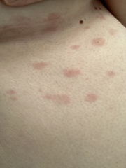 Red patch on left breast early pregnancy?