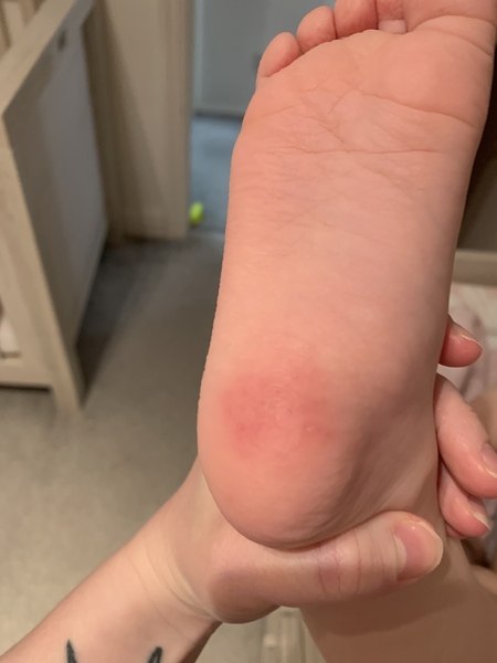 Red rash on soles of toddler feet