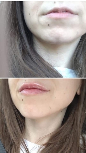 Lip fillers