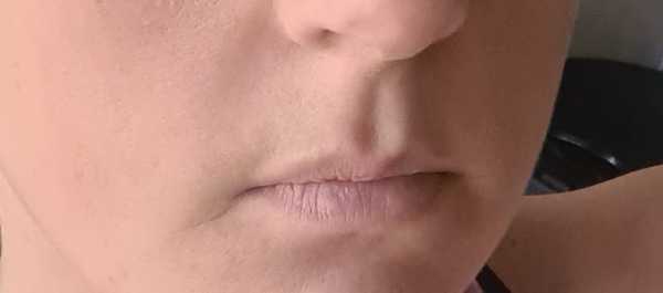 Lip fillers