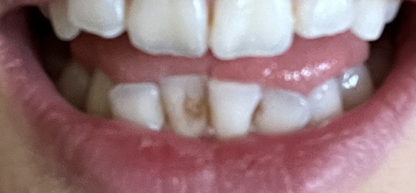 Stain on tooth- any dentists/hygienists out there?
