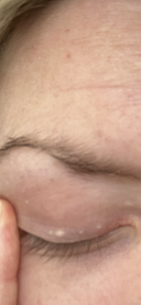 Spots on my eye