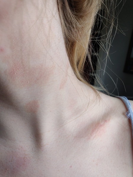 Red patches on neck