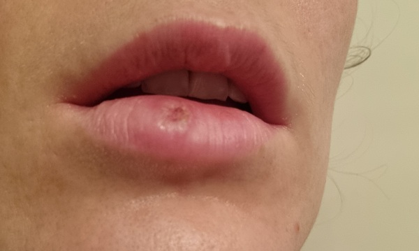 What's happened to my lip?