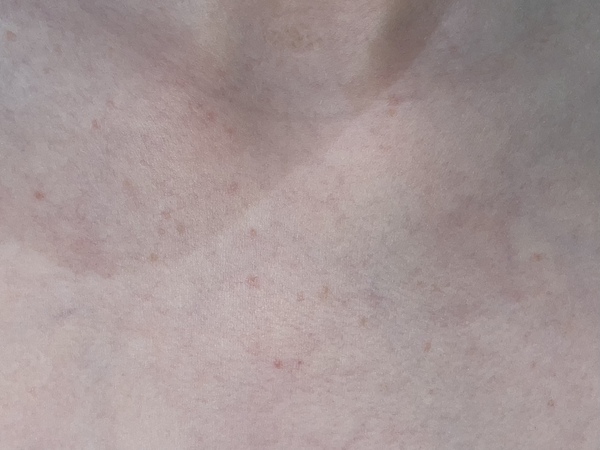 Daughters rash