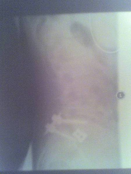 L5-S1 Spinal Fusion and Pregnancy/Delivery