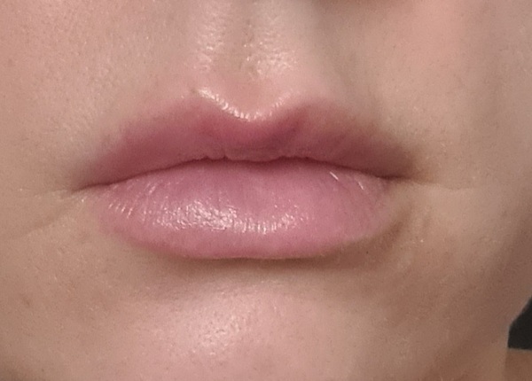 Lip fillers