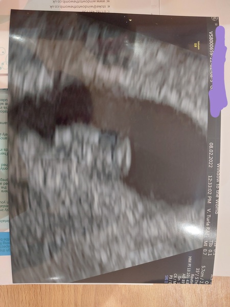 Potentially 6 weeks plus 4 and having and early scan tomorrow. Anyone else had a scan at 6 weeks?