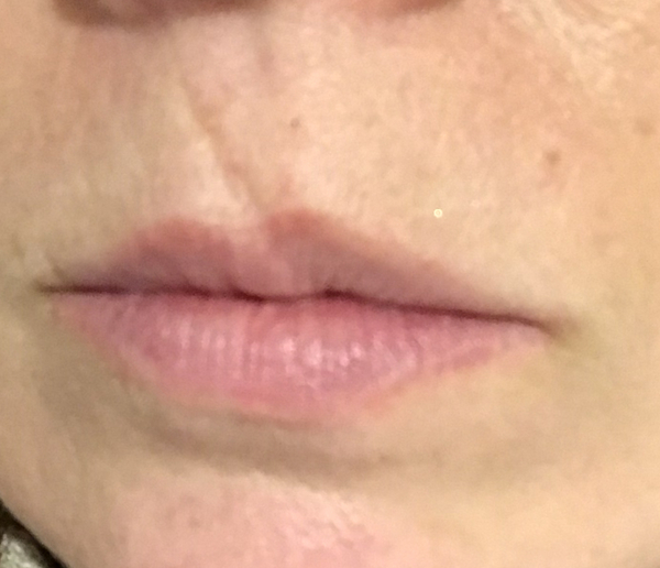 Facial Scar