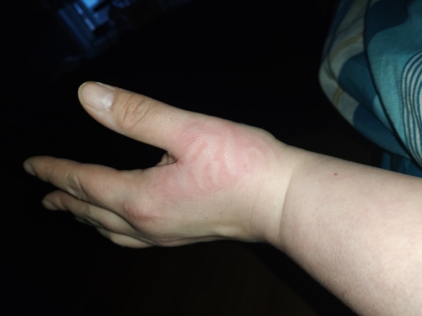 Treatment for burn
