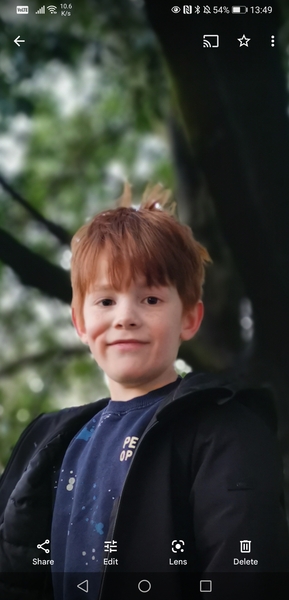 Dimple caused by cheek injury