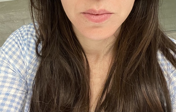 Lip fillers