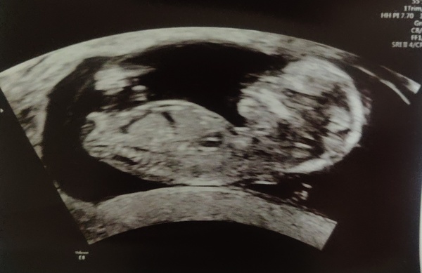 Boy or Girl ?