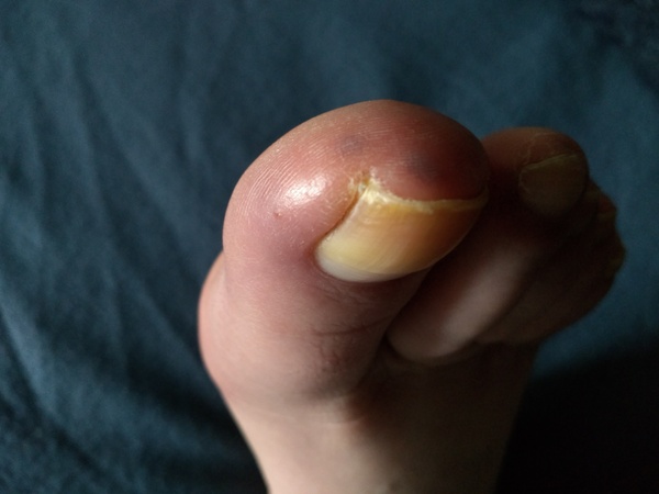 What's this on my toes? Manky foot pic warning