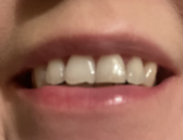 Arghh! Chipped my front tooth! Is it going to cost me a fortune to repair?
