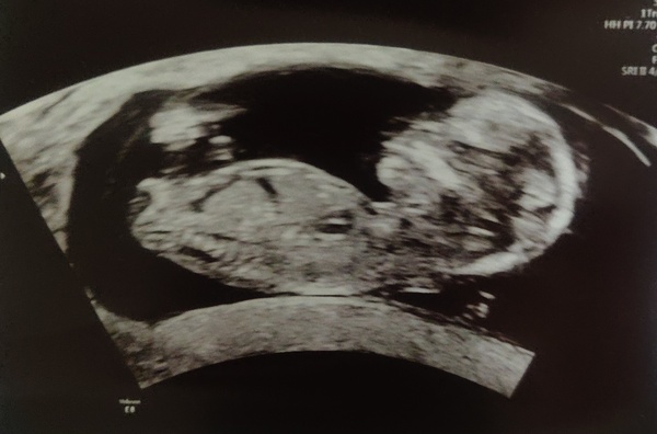 17 week scan vs 13 week