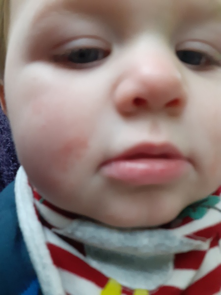 What is this rash?