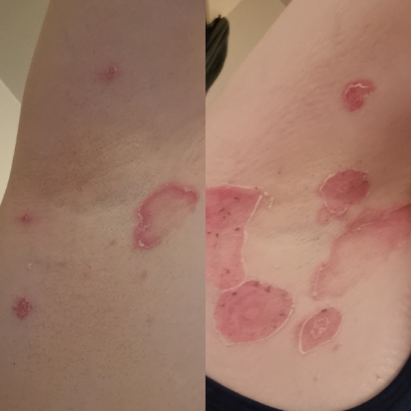 What does this rash look like to you?